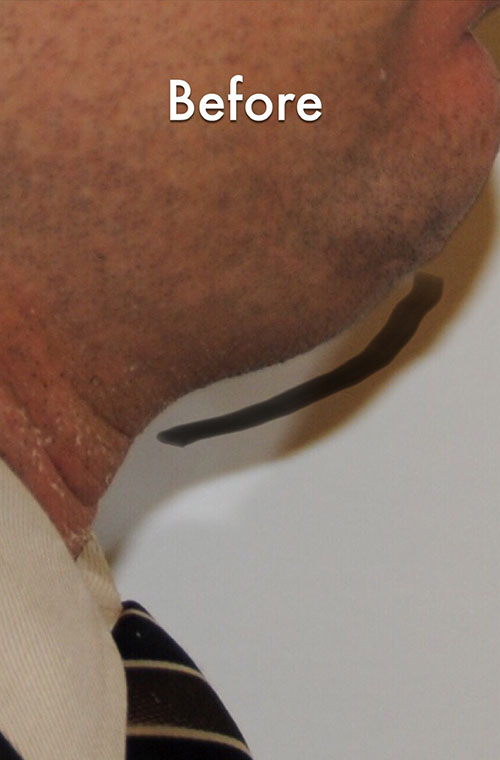 Neck Liposuction Before & After Gallery - Patient 290709 - Image 1