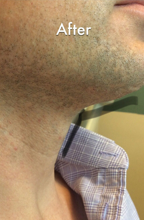 Neck Liposuction Before & After Gallery - Patient 290709 - Image 2