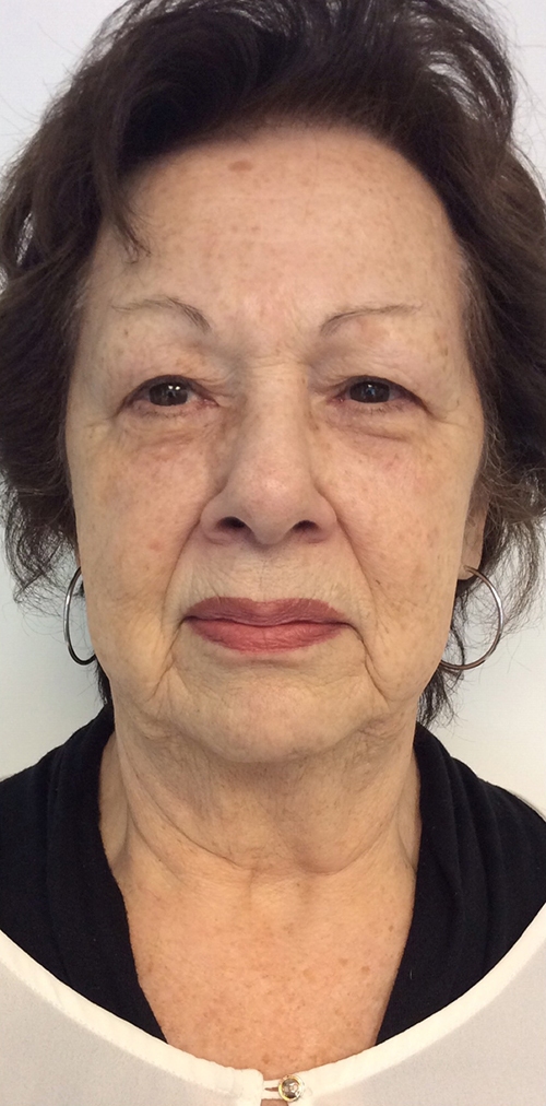 Diamond Glow Before & After Gallery - Patient 118561 - Image 1