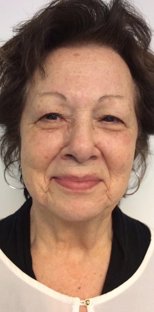 Diamond Glow Before & After Gallery - Patient 118561 - Image 2