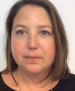 Vbeam Before & After Gallery - Patient 108352 - Image 3