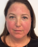 Vbeam Before & After Gallery - Patient 108352 - Image 4