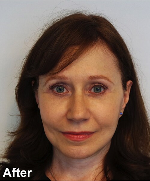 Facelift Before & After Gallery - Patient 245710 - Image 2