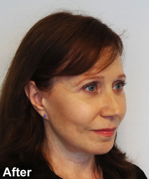 Facelift Before & After Gallery - Patient 245710 - Image 4