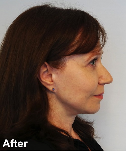 Facelift Before & After Gallery - Patient 245710 - Image 6