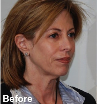 Facelift Before & After Gallery - Patient 335222 - Image 3