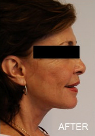 Facelift Before & After Gallery - Patient 334142 - Image 2