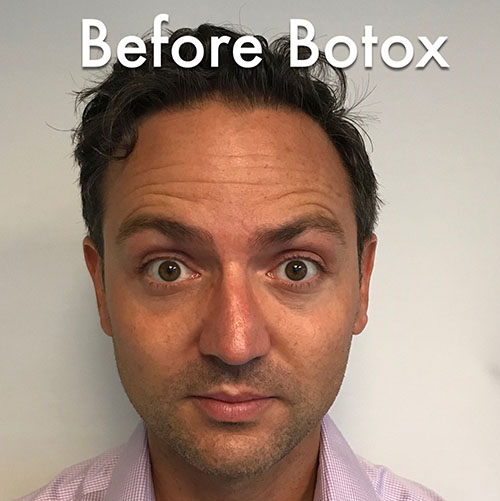 BOTOX® Before & After Gallery - Patient 335661 - Image 1