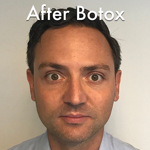 BOTOX® Before & After Gallery - Patient 335661 - Image 2