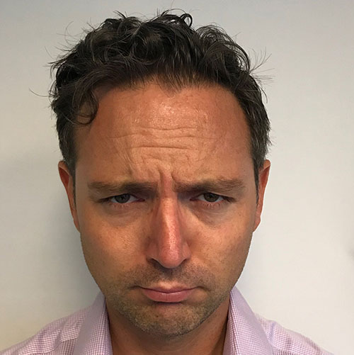 BOTOX® Before & After Gallery - Patient 335661 - Image 3