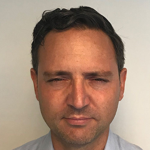 BOTOX® Before & After Gallery - Patient 335661 - Image 4