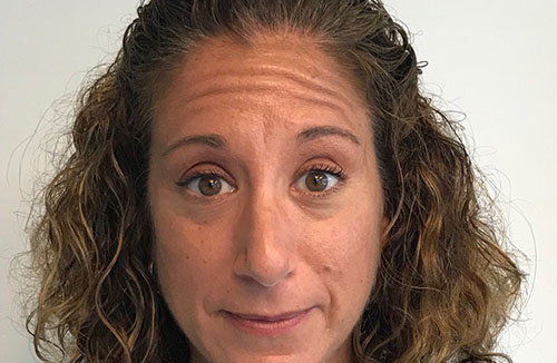 BOTOX® Before & After Gallery - Patient 202973 - Image 1