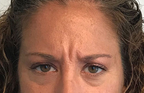 BOTOX® Before & After Gallery - Patient 202973 - Image 3