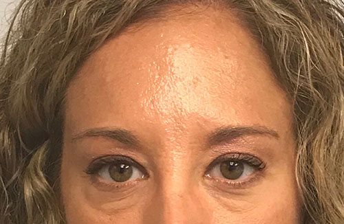 BOTOX® Before & After Gallery - Patient 202973 - Image 4