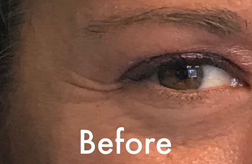 BOTOX® Before & After Gallery - Patient 202973 - Image 5