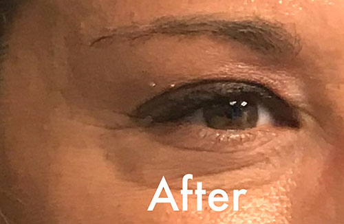 BOTOX® Before & After Gallery - Patient 202973 - Image 6