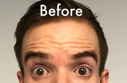 BOTOX® Before & After Gallery - Patient 321022 - Image 1