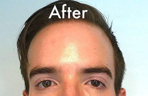 BOTOX® Before & After Gallery - Patient 321022 - Image 2