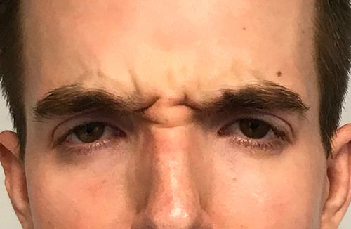 BOTOX® Before & After Gallery - Patient 321022 - Image 3