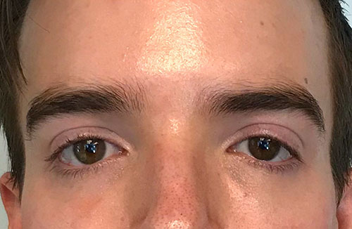 BOTOX® Before & After Gallery - Patient 321022 - Image 4