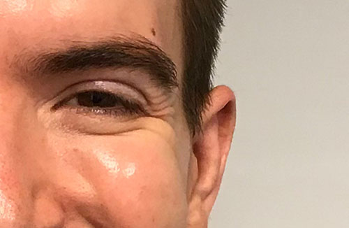 BOTOX® Before & After Gallery - Patient 321022 - Image 5