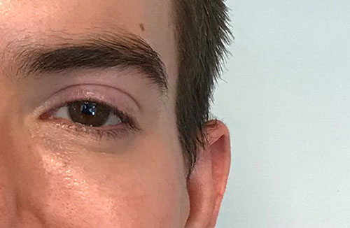 BOTOX® Before & After Gallery - Patient 321022 - Image 6