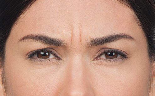 BOTOX® Before & After Gallery - Patient 597735 - Image 1