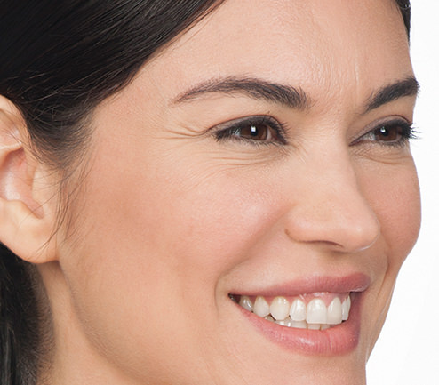 BOTOX® Before & After Gallery - Patient 597735 - Image 3