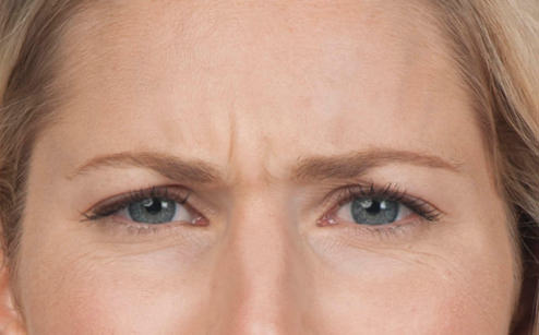 BOTOX® Before & After Gallery - Patient 387208 - Image 1