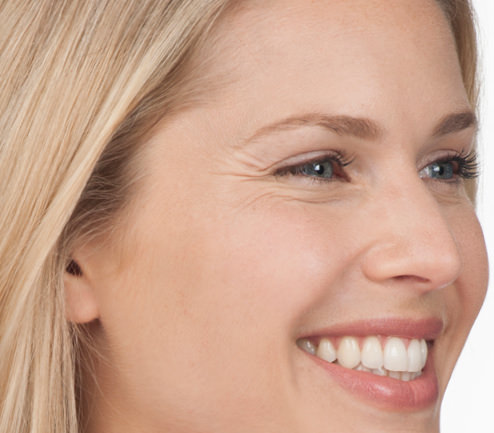 BOTOX® Before & After Gallery - Patient 387208 - Image 3