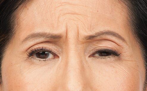 BOTOX® Before & After Gallery - Patient 264984 - Image 1