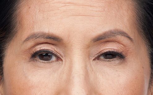 BOTOX® Before & After Gallery - Patient 264984 - Image 2
