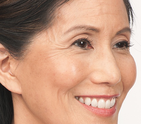 BOTOX® Before & After Gallery - Patient 264984 - Image 3