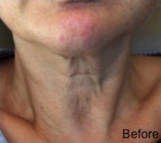 Kybella Before & After Gallery - Patient 252218 - Image 1