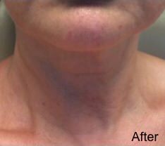 Kybella Before & After Gallery - Patient 252218 - Image 2