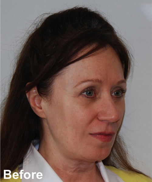 Blepharoplasty Before & After Gallery - Patient 112715 - Image 3