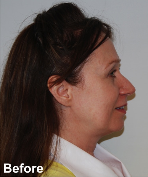 Blepharoplasty Before & After Gallery - Patient 112715 - Image 5