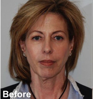 Blepharoplasty Before & After Gallery - Patient 349563 - Image 1