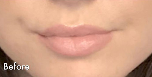 Juvéderm® Before & After Gallery - Patient 263768 - Image 1