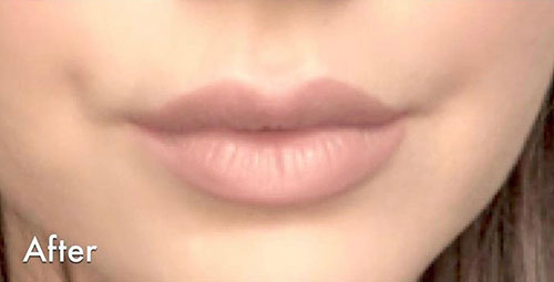 Juvéderm® Before & After Gallery - Patient 263768 - Image 2