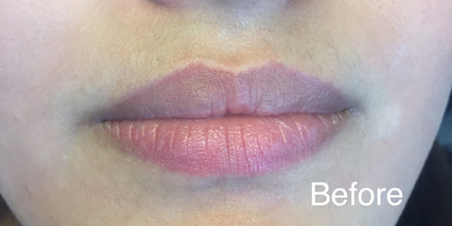 Juvéderm® Before & After Gallery - Patient 164938 - Image 1