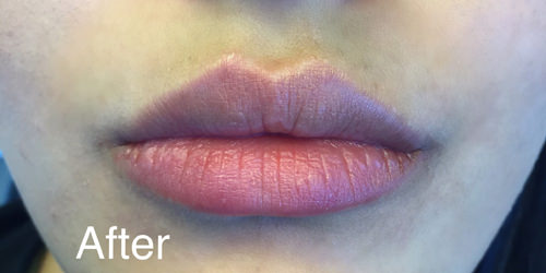 Juvéderm® Before & After Gallery - Patient 164938 - Image 2