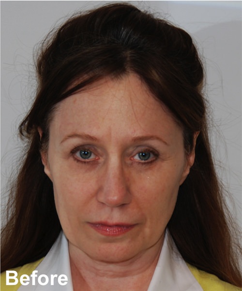 Neck Lift Before & After Gallery - Patient 182828 - Image 1