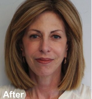 Neck Lift Before & After Gallery - Patient 209536 - Image 2