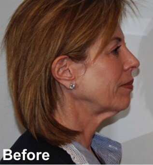 Neck Lift Before & After Gallery - Patient 209536 - Image 5