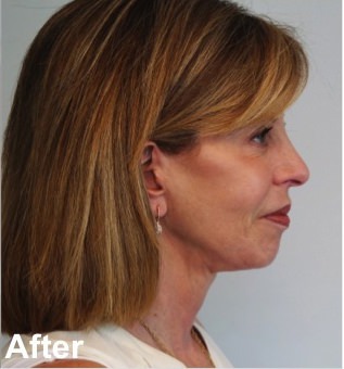 Neck Lift Before & After Gallery - Patient 209536 - Image 6