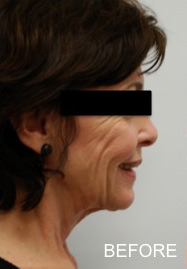 Neck Lift Before & After Gallery - Patient 258443 - Image 1