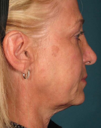 Ulthera Before & After Gallery - Patient 768503 - Image 1