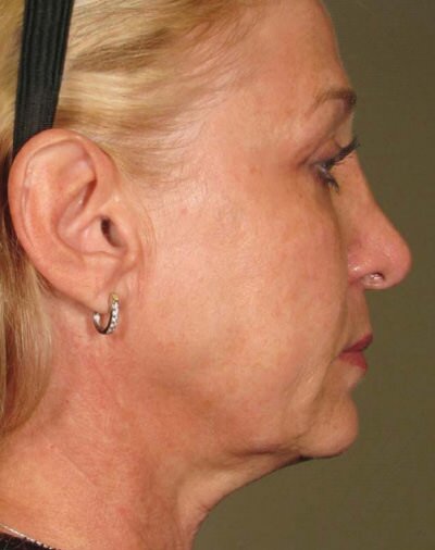 Ulthera Before & After Gallery - Patient 768503 - Image 2