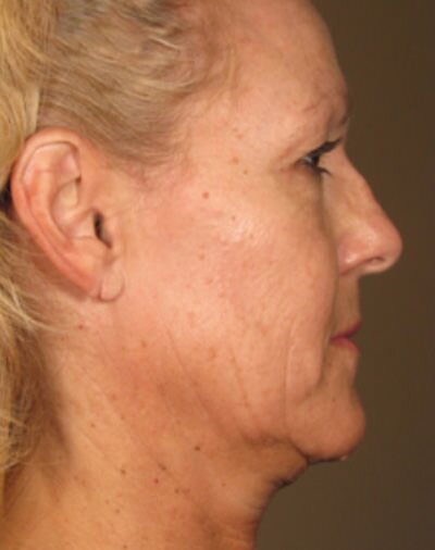 Ulthera Before & After Gallery - Patient 303722 - Image 1